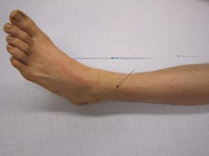 Electrocution injury from lightning- non-severe